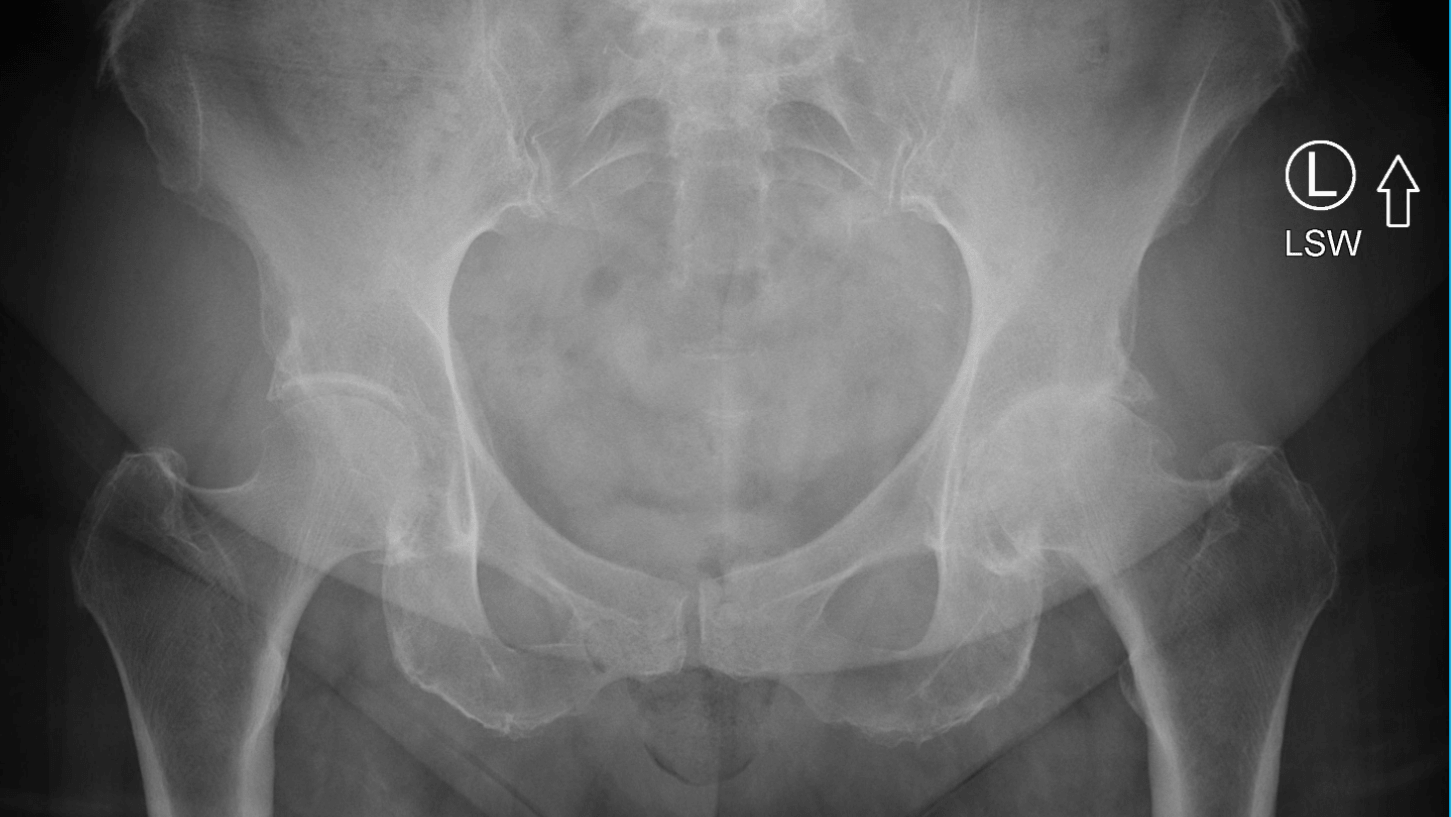 Hip Arthritis Xray